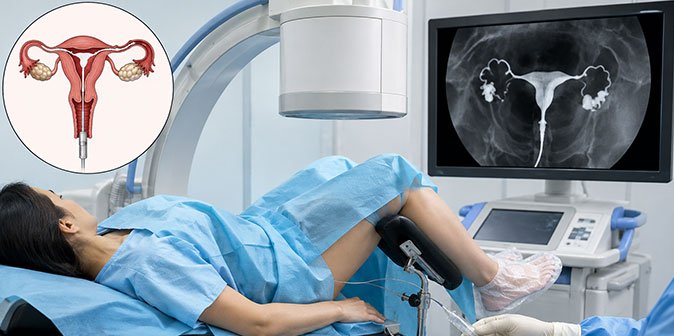 hysterosalpingography